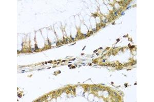 Immunohistochemistry of paraffin-embedded Human colon carcinoma using PMPCB Polyclonal Antibody at dilution of 1:100 (40x lens). (PMPCB Antikörper)