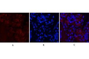 Immunofluorescence analysis of human lung cancer tissue. (Notch1 Antikörper  (Cleaved-Val1754))