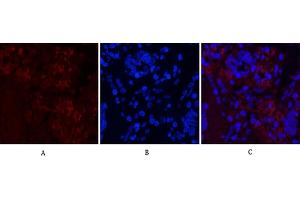 Immunofluorescence analysis of human lung cancer tissue. (Notch1 Antikörper  (Cleaved-Val1754))