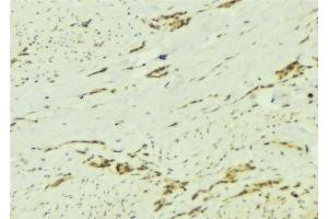 ABIN6276892 at 1/100 staining Human breast cancer tissue by IHC-P. (PTPN2 Antikörper  (C-Term))