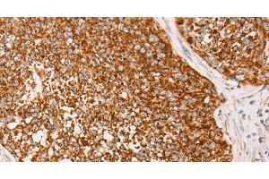 Immunohistochemistry of paraffin-embedded Human cervical cancer using AK2 Polyclonal Antibody at dilution of 1:40