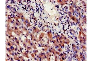 Immunohistochemistry of paraffin-embedded human liver cancer using ABIN7156348 at dilution of 1:100 (INSIG1 Antikörper  (AA 1-87))