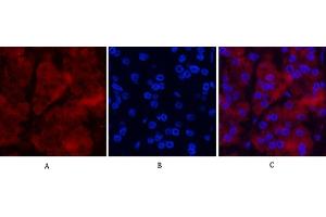 Immunofluorescence analysis of human stomach cancer tissue. (Ubiquitin Antikörper)