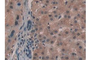 Detection of GaA in Human Liver cancer Tissue using Polyclonal Antibody to Glucosidase Alpha, Acid (GaA) (GAA Antikörper  (AA 595-770))