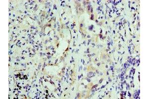 Immunohistochemistry of paraffin-embedded human lung cancer using ABIN7156126 at dilution of 1:100 (KPNA1 Antikörper  (AA 8-538))