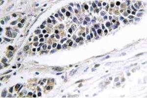 Immunohistochemistry (IHC) analyzes of KDEL Receptor 2 antibody in paraffin-embedded human lung carcinoma tissue. (KDELR2 Antikörper)