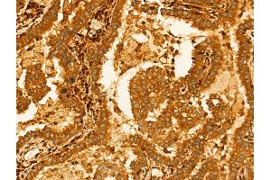 ABIN7094259 and ABIN7098306 at 1/100 staining Human lung cancer by IHC-P.