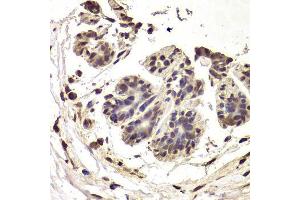 Immunohistochemistry of paraffin-embedded human breast cancer using INTS6 Antibody. (INTS6 Antikörper  (AA 1-280))