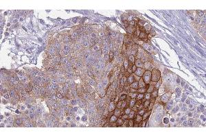 ABIN6279169 at 1/100 staining Human urothelial cancer tissue by IHC-P. (ABCC9 Antikörper  (C-Term))
