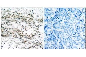 Immunohistochemical analysis of paraffin- embedded human breast carcinoma tissue using AFX (phospho-Ser197) antibody (E011137). (FOXO4 Antikörper  (pSer197))