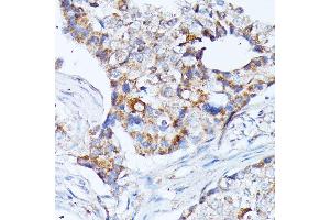Immunohistochemistry of paraffin-embedded human breast cancer using KCNJ15 antibody (ABIN7269475) at dilution of 1:100 (40x lens). (KCNJ15 Antikörper  (AA 221-375))