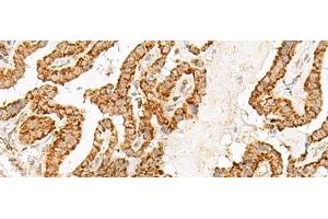 Immunohistochemistry of paraffin-embedded Human thyroid cancer tissue using NUP210 Polyclonal Antibody at dilution of 1:30(x200) (NUP210 Antikörper)