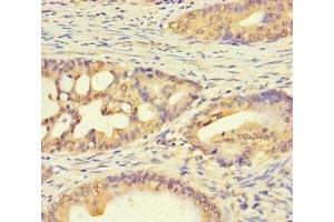 Immunohistochemistry of paraffin-embedded human colon cancer using ABIN7174792 at dilution of 1:100 (C1ORF53 Antikörper  (AA 1-145))