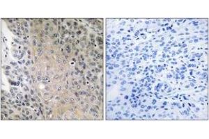 Immunohistochemistry analysis of paraffin-embedded human lung carcinoma, using RAB41 Antibody.