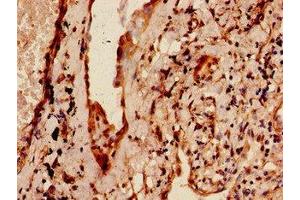 Immunohistochemistry of paraffin-embedded human lung cancer using ABIN7159758 at dilution of 1:100