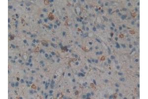 Detection of MAPK11 in Human Glioma Tissue using Polyclonal Antibody to Mitogen Activated Protein Kinase 11 (MAPK11) (MAPK11 Antikörper  (AA 38-277))