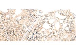 Immunohistochemistry of paraffin-embedded Human gastric cancer tissue using DCP2 Polyclonal Antibody at dilution of 1:45(x200)