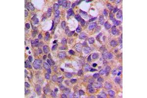 Immunohistochemical analysis of S6K1 (pT444) staining in human breast cancer formalin fixed paraffin embedded tissue section. (RPS6KB1 Antikörper  (C-Term, pSer444))