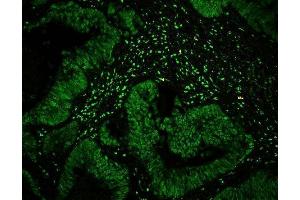 IF analysis of CTBP1 using anti-CTBP1 antibody (ABIN3043816) CTBP1 was detected in paraffin-embedded section of human intestinal cancer tissues. (CTBP1 Antikörper  (C-Term))