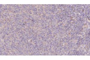 ABIN6273077 at 1/100 staining Human lymph cancer tissue by IHC-P. (SRP9 Antikörper  (Internal Region))