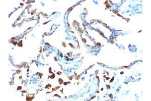 FFPE human lung carcinoma tested with MFGE8 antibody (MFG-06) (MFGE8 Antikörper)