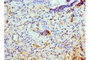 Immunohistochemistry of paraffin-embedded human lung cancer using ABIN7145103 at dilution of 1:100 (ATG13 Antikörper  (AA 318-517))
