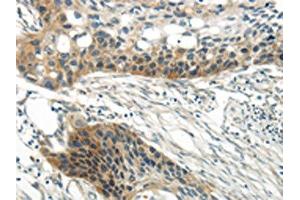 The image on the left is immunohistochemistry of paraffin-embedded Human esophagus cancer tissue using ABIN7193067(WNT6 Antibody) at dilution 1/35, on the right is treated with synthetic peptide.