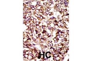 Formalin-fixed and paraffin-embedded human hepatocellular carcinoma tissue reacted with CDK2 polyclonal antibody  , which was peroxidase-conjugated to the secondary antibody, followed by DAB staining. (CDK2 Antikörper  (C-Term))