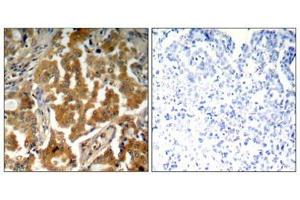 Immunohistochemical analysis of paraffin-embedded human lung carcinoma tissue using ADD1(Phospho-Ser726) Antibody(left) or the same antibody preincubated with blocking peptide(right). (alpha Adducin Antikörper  (pSer726))