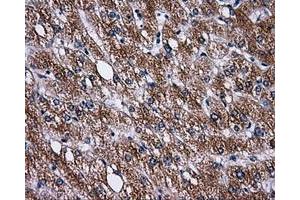Immunohistochemical staining of paraffin-embedded Carcinoma of liver tissue using anti-PASKmouse monoclonal antibody. (PASK Antikörper)
