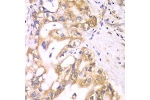 Immunohistochemistry of paraffin-embedded human liver cancer using ACADS antibody. (ACADS Antikörper  (AA 1-260))