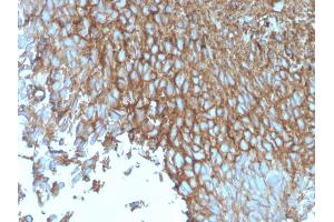 Formalin-fixed, paraffin-embedded human Bladder stained with GLUT-1 Mouse Monoclonal Antibody (rGLUT1/2476).