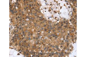 Immunohistochemistry of Human lung cancer using TPM2 Polyclonal Antibody at dilution of 1:35 (TPM2 Antikörper)