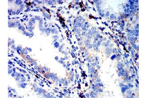 Immunohistochemical analysis of paraffin-embedded endometrial cancer tissues using IGLC2 mouse mAb with DAB staining.