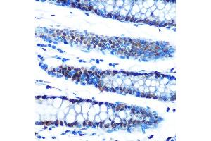 Immunohistochemistry of paraffin-embedded human colon using  Rabbit mAb (ABIN7265458) at dilution of 1:100 (40x lens). (ADAR Antikörper)