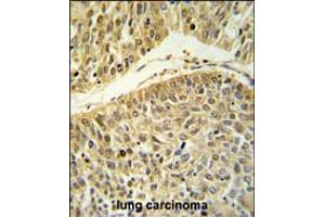 RERE Antibody IHC analysis in formalin fixed and paraffin embedded lung carcinoma followed by peroxidase conjugation of the secondary antibody and DAB staining.