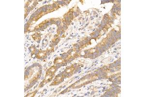 Immunohistochemistry of paraffin-embedded human colon carcinoma using NUDT19 Rabbit mAb (ABIN7269070) at dilution of 1:25 (40x lens).