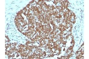 Formalin-fixed, paraffin-embedded human ovarian carcinoma stained with Nucleolin antibody.