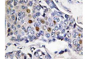 Immunohistochemical analysis of paraffin-embedded human breast cancer tissue using POLR3A polyclonal antibody . (POLR3A Antikörper)