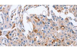 Immunohistochemistry of paraffin-embedded Human lung cancer tissue using NRG4 Polyclonal Antibody at dilution 1:60 (Neuregulin 4 Antikörper)