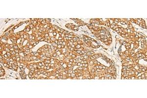 Immunohistochemistry of paraffin-embedded Human liver cancer tissue using DARS Polyclonal Antibody at dilution of 1:25(x200) (DARS Antikörper)
