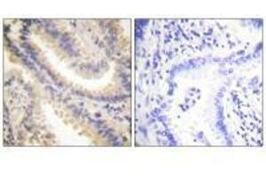 Immunohistochemistry analysis of paraffin-embedded human lung carcinoma tissue using TIMP4 antibody. (TIMP4 Antikörper  (C-Term))