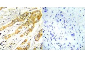 Immunohistochemical analysis of paraffin- embedded human breast carcinoma tissue using ERK1/2 (Thr202/Tyr204) antibody (E022017). (ERK1/2 Antikörper)