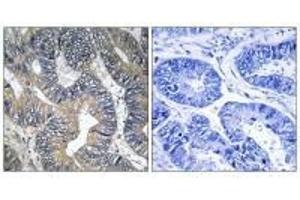 Immunohistochemistry analysis of paraffin-embedded human colon carcinoma tissue using GTPBP2 antibody. (GTPBP2 Antikörper)