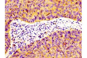 IHC image of ABIN7152965 diluted at 1:100 and staining in paraffin-embedded human cervical cancer performed on a Leica BondTM system. (Flotillin 1 Antikörper  (AA 169-251))