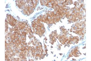Formalin-fixed, paraffin-embedded human Urothelial Carcinoma stained with PAI-RBP1 Mouse Monoclonal Antibody (SERBP1/3498). (SERBP1 Antikörper  (AA 3-139))