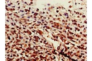 Immunohistochemistry of paraffin-embedded human melanoma using ABIN7143911 at dilution of 1:100 (ST6GALNAC1 Antikörper  (AA 36-249))