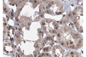 ABIN6267701 at 1/100 staining human kindey carcinoma tissue sections by IHC-P. (CaMK2 alpha/beta/delta Antikörper  (pThr305))