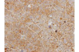 IHC-P Image Immunohistochemical analysis of paraffin-embedded SW480 xenograft, using CHI3L2, antibody at 1:500 dilution. (CHI3L2 Antikörper)