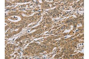 The image on the left is immunohistochemistry of paraffin-embedded Human gastric cancer tissue using ABIN7129118(CYFIP2 Antibody) at dilution 1/25, on the right is treated with fusion protein. (CYFIP2 Antikörper)